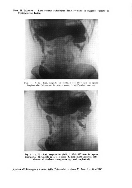 Rivista di patologia e clinica della tubercolosi organo ufficiale della Società italiana fascista di studi scientifici sulla tubercolosi