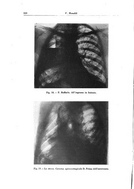 Rivista di patologia e clinica della tubercolosi organo ufficiale della Società italiana fascista di studi scientifici sulla tubercolosi