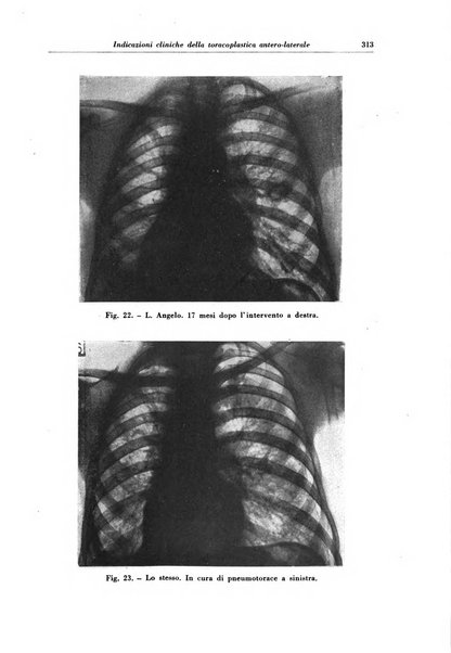 Rivista di patologia e clinica della tubercolosi organo ufficiale della Società italiana fascista di studi scientifici sulla tubercolosi