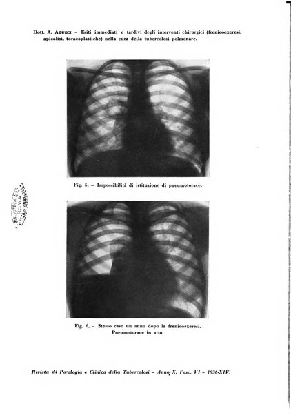 Rivista di patologia e clinica della tubercolosi organo ufficiale della Società italiana fascista di studi scientifici sulla tubercolosi