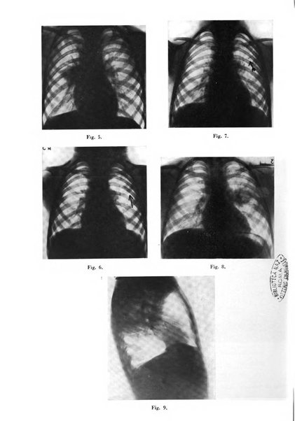 Rivista di patologia e clinica della tubercolosi organo ufficiale della Società italiana fascista di studi scientifici sulla tubercolosi