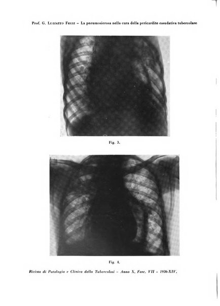 Rivista di patologia e clinica della tubercolosi organo ufficiale della Società italiana fascista di studi scientifici sulla tubercolosi