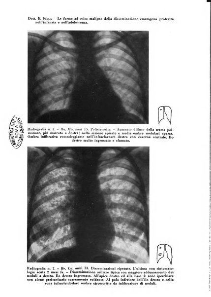 Rivista di patologia e clinica della tubercolosi organo ufficiale della Società italiana fascista di studi scientifici sulla tubercolosi