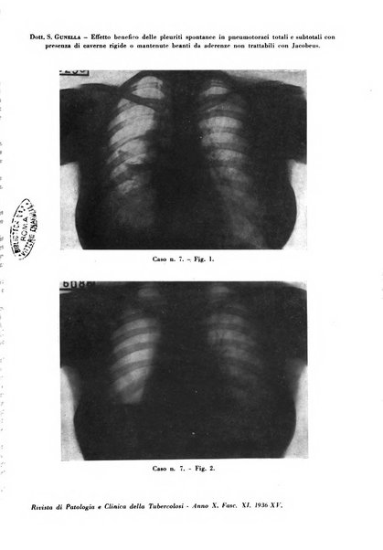 Rivista di patologia e clinica della tubercolosi organo ufficiale della Società italiana fascista di studi scientifici sulla tubercolosi