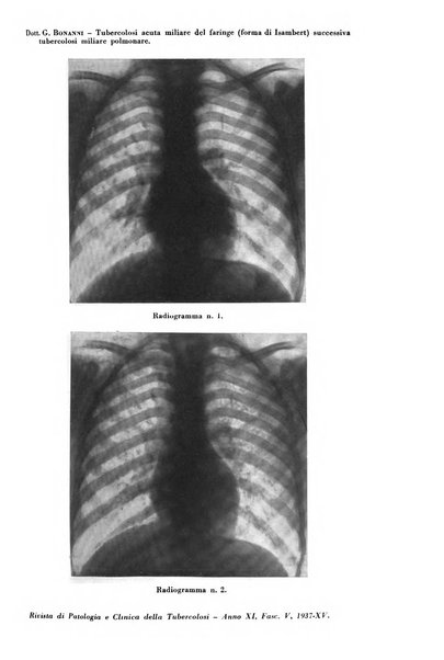 Rivista di patologia e clinica della tubercolosi organo ufficiale della Società italiana fascista di studi scientifici sulla tubercolosi