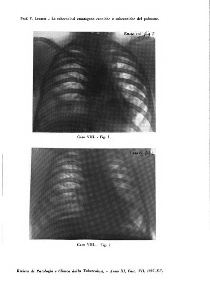 Rivista di patologia e clinica della tubercolosi organo ufficiale della Società italiana fascista di studi scientifici sulla tubercolosi