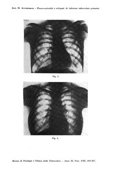 Rivista di patologia e clinica della tubercolosi organo ufficiale della Società italiana fascista di studi scientifici sulla tubercolosi