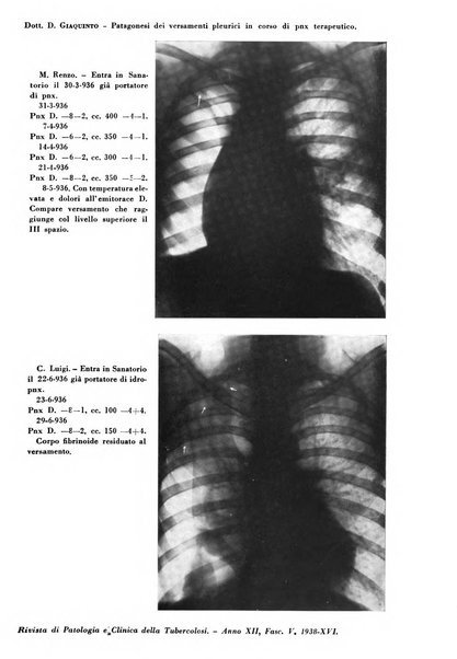 Rivista di patologia e clinica della tubercolosi organo ufficiale della Società italiana fascista di studi scientifici sulla tubercolosi