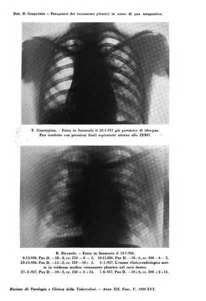 Rivista di patologia e clinica della tubercolosi organo ufficiale della Società italiana fascista di studi scientifici sulla tubercolosi