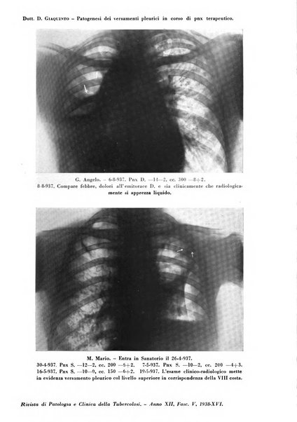 Rivista di patologia e clinica della tubercolosi organo ufficiale della Società italiana fascista di studi scientifici sulla tubercolosi