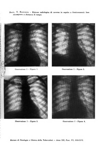 Rivista di patologia e clinica della tubercolosi organo ufficiale della Società italiana fascista di studi scientifici sulla tubercolosi