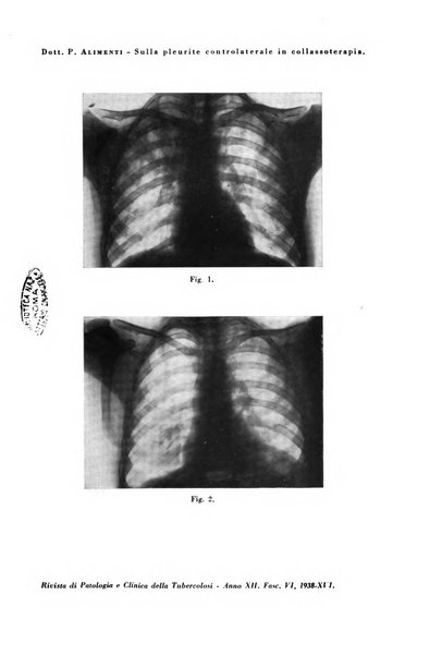 Rivista di patologia e clinica della tubercolosi organo ufficiale della Società italiana fascista di studi scientifici sulla tubercolosi