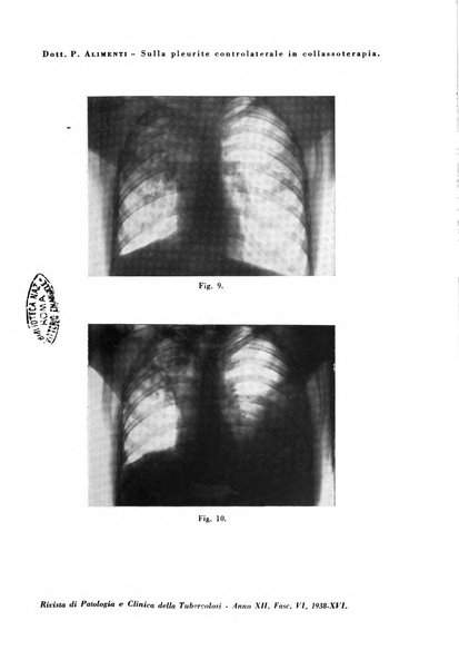 Rivista di patologia e clinica della tubercolosi organo ufficiale della Società italiana fascista di studi scientifici sulla tubercolosi