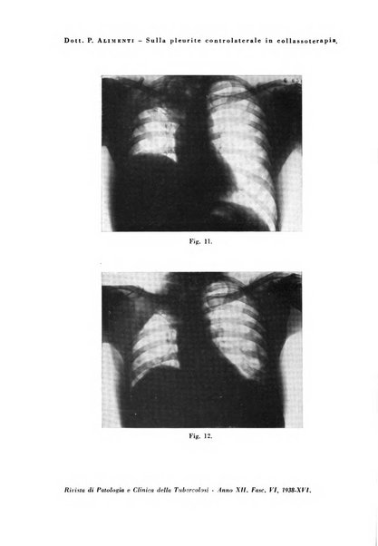 Rivista di patologia e clinica della tubercolosi organo ufficiale della Società italiana fascista di studi scientifici sulla tubercolosi