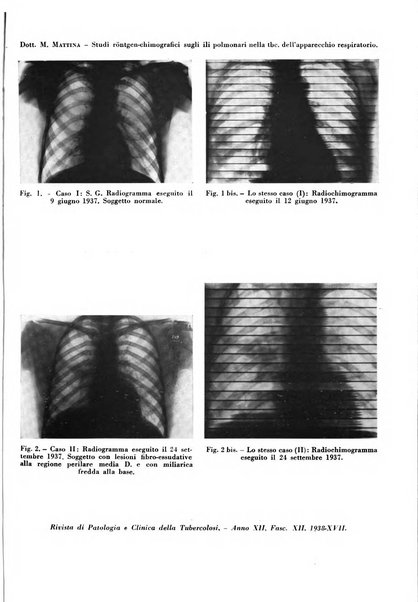 Rivista di patologia e clinica della tubercolosi organo ufficiale della Società italiana fascista di studi scientifici sulla tubercolosi