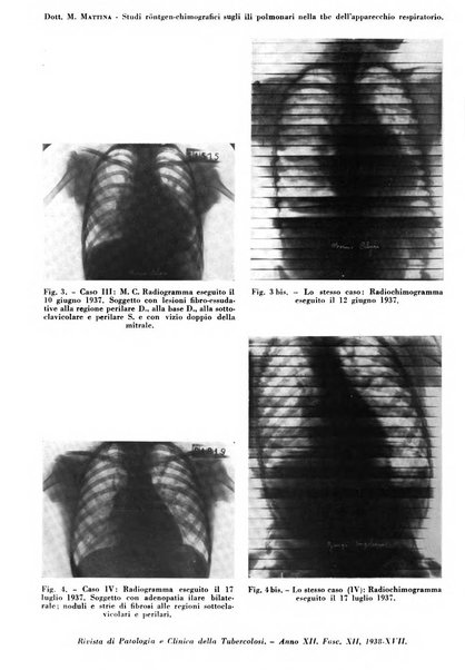 Rivista di patologia e clinica della tubercolosi organo ufficiale della Società italiana fascista di studi scientifici sulla tubercolosi