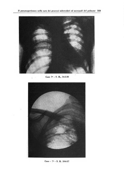 Rivista di patologia e clinica della tubercolosi organo ufficiale della Società italiana fascista di studi scientifici sulla tubercolosi