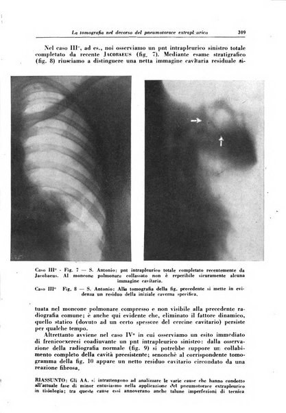 Rivista di patologia e clinica della tubercolosi organo ufficiale della Società italiana fascista di studi scientifici sulla tubercolosi