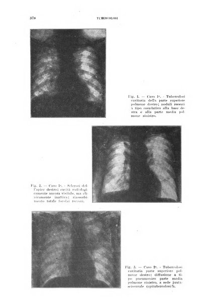 Tubercolosi giornale di studi e di lotta antitubercolare