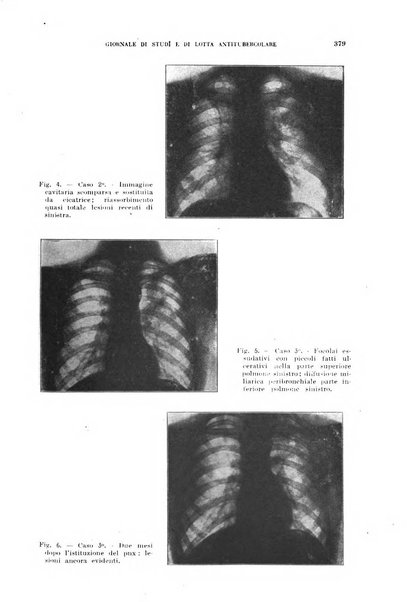 Tubercolosi giornale di studi e di lotta antitubercolare