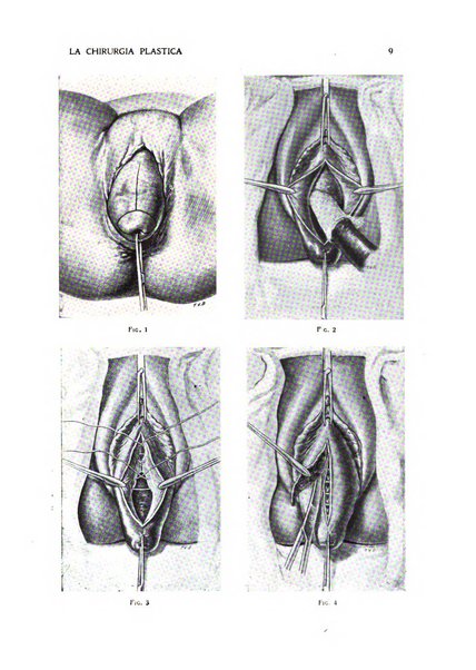 La chirurgia plastica rivista della Societa italiana di chirurgia riparatrice plastica ed estetica