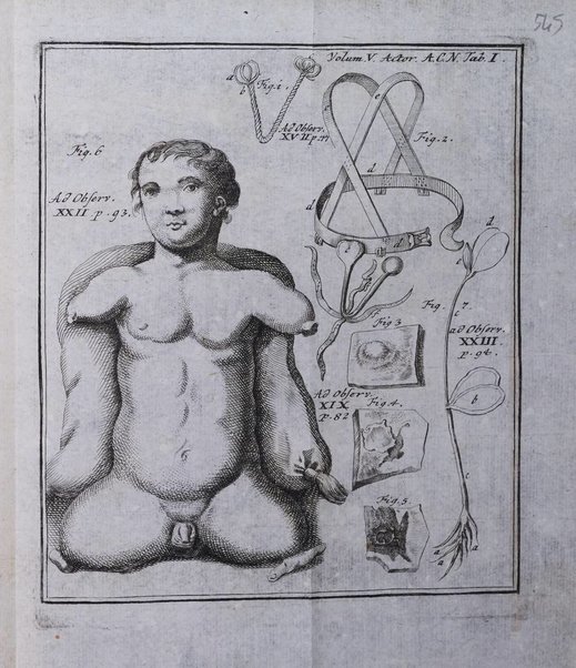 Acta physico-medica Academiae caesareae leopoldino-carolinae naturae curiosorum exhibentia ephemerides sive oservationes historias et experimenta a celeberrimis Germaniae et exterarum regionum viris habita et communicata..