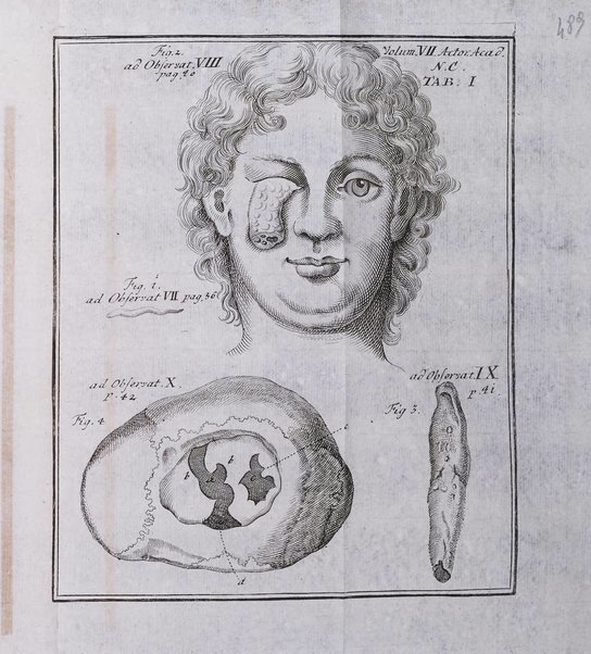 Acta physico-medica Academiae caesareae leopoldino-carolinae naturae curiosorum exhibentia ephemerides sive oservationes historias et experimenta a celeberrimis Germaniae et exterarum regionum viris habita et communicata..