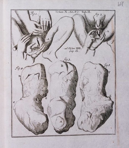 Acta physico-medica Academiae caesareae leopoldino-carolinae naturae curiosorum exhibentia ephemerides sive oservationes historias et experimenta a celeberrimis Germaniae et exterarum regionum viris habita et communicata..