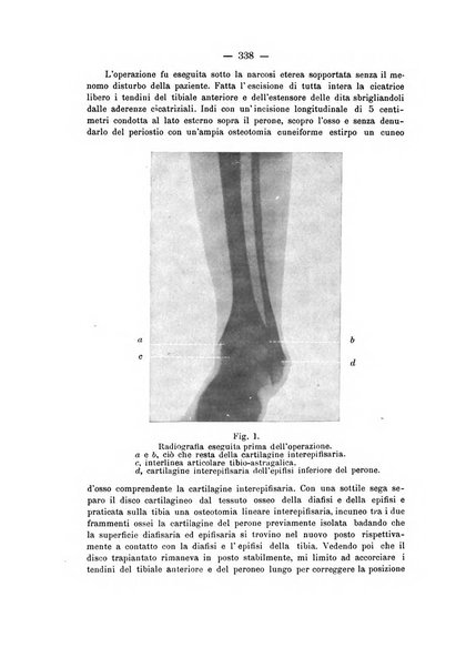 Archivio di ortopedia pubblicazione ufficiale del Pio istituto dei rachitici <1924-1950>