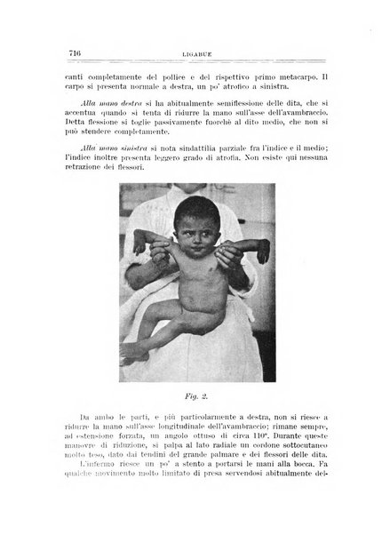 Archivio di ortopedia pubblicazione ufficiale del Pio istituto dei rachitici <1924-1950>