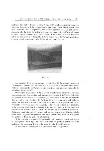 Archivio di ortopedia pubblicazione ufficiale del Pio istituto dei rachitici <1924-1950>