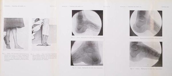 Archivio di ortopedia pubblicazione ufficiale del Pio istituto dei rachitici <1924-1950>