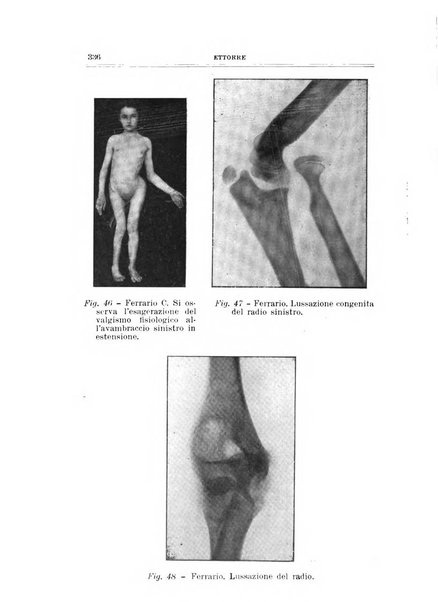 Archivio di ortopedia pubblicazione ufficiale del Pio istituto dei rachitici <1924-1950>