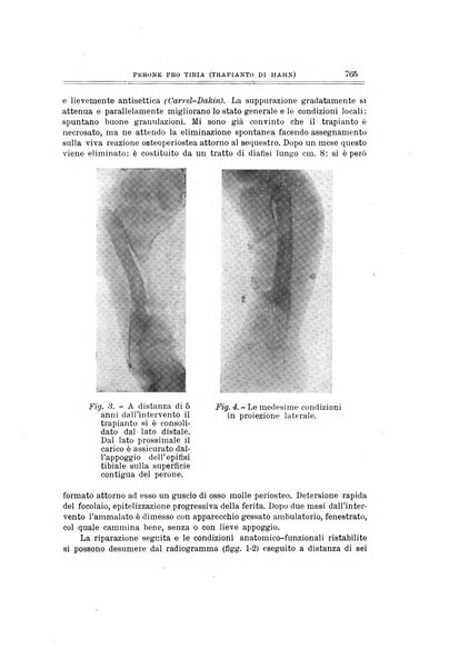 Archivio di ortopedia pubblicazione ufficiale del Pio istituto dei rachitici <1924-1950>