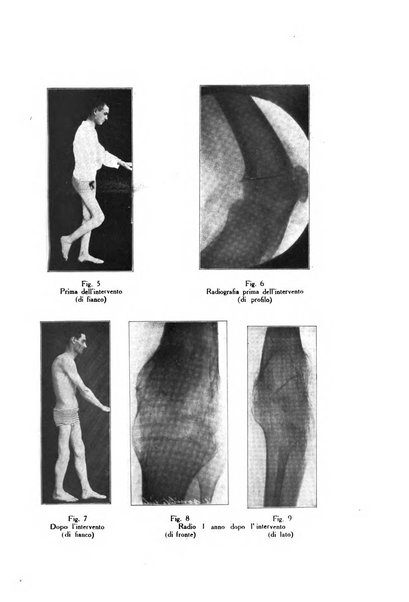 Archivio di ortopedia pubblicazione ufficiale del Pio istituto dei rachitici <1924-1950>