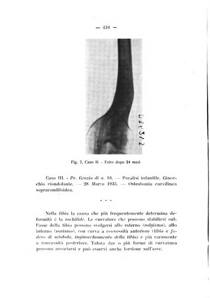 Archivio di ortopedia pubblicazione ufficiale del Pio istituto dei rachitici <1924-1950>