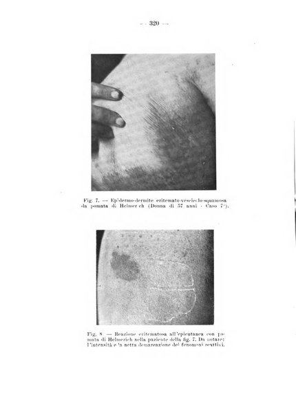 Il dermosifilografo gazzetta di dermosifilografia per il medico pratico