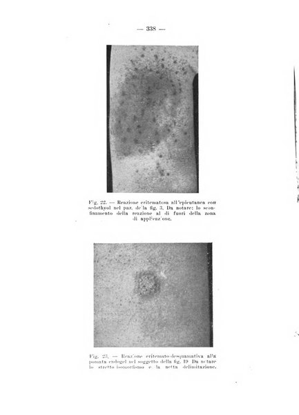 Il dermosifilografo gazzetta di dermosifilografia per il medico pratico