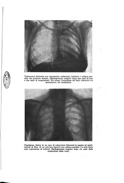 Lotta contro la tubercolosi rivista mensile