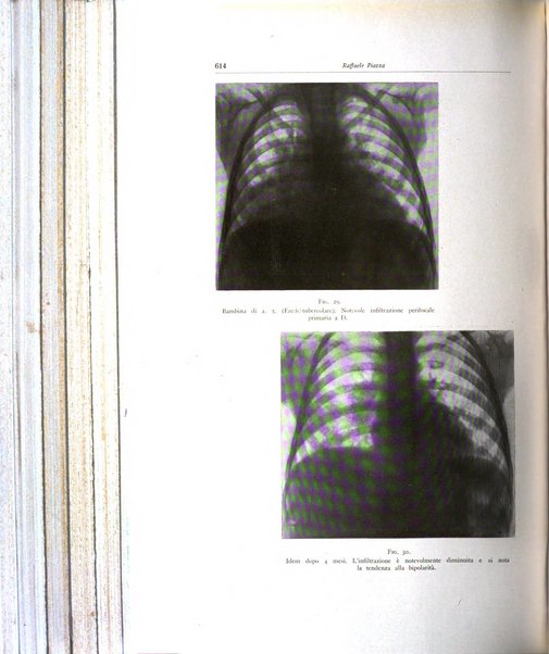 Lotta contro la tubercolosi rivista mensile