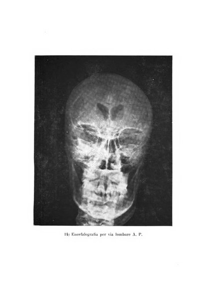 Schizofrenie bollettino trimestrale del primo Centro Provinciale di studio della demenza precoce