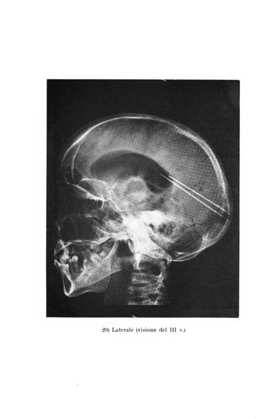 Schizofrenie bollettino trimestrale del primo Centro Provinciale di studio della demenza precoce