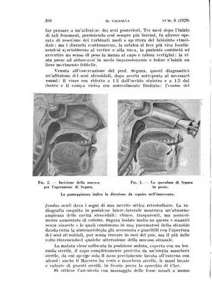 Il Valsalva rivista mensile di oto-rino-laringojatria