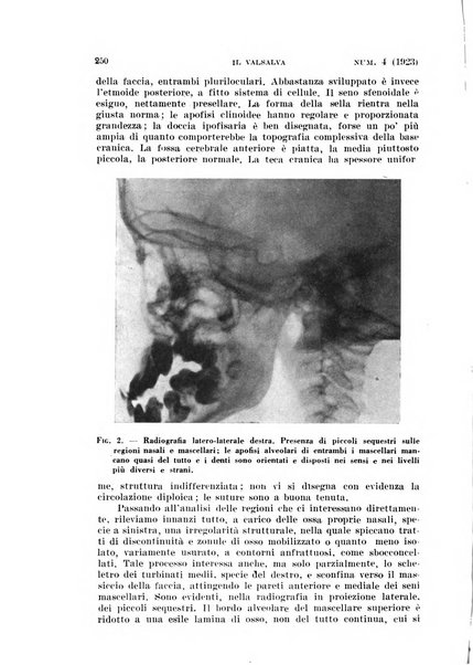 Il Valsalva rivista mensile di oto-rino-laringojatria