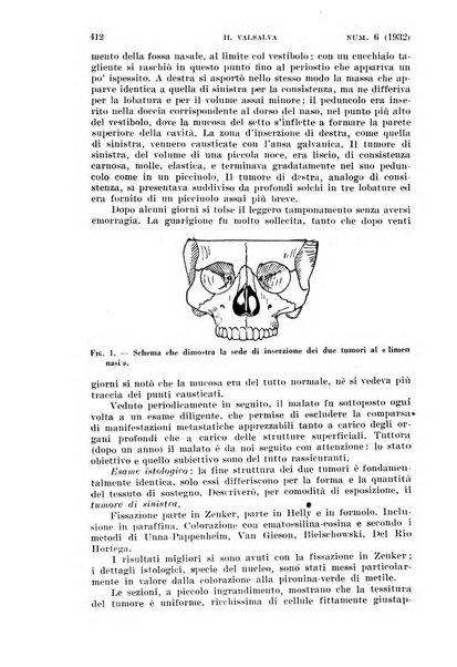 Il Valsalva rivista mensile di oto-rino-laringojatria