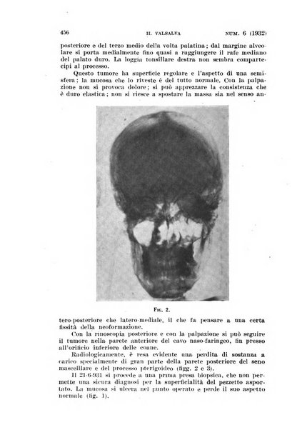 Il Valsalva rivista mensile di oto-rino-laringojatria