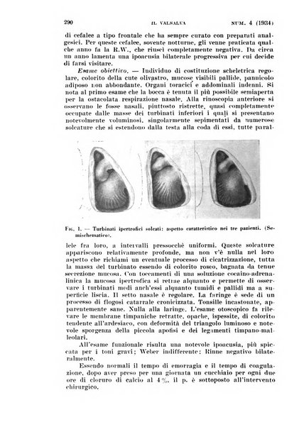 Il Valsalva rivista mensile di oto-rino-laringojatria