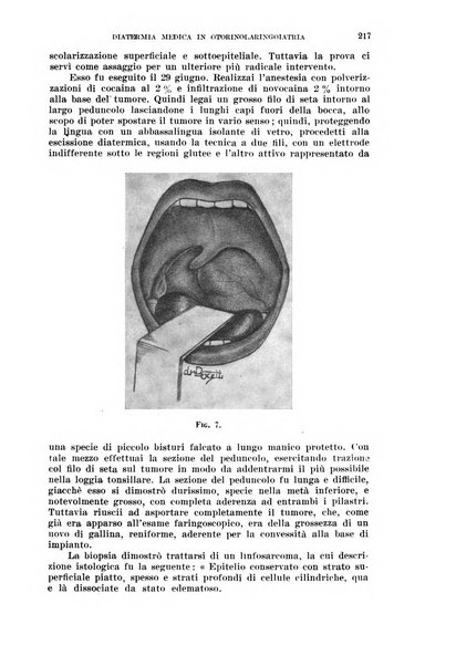 Il Valsalva rivista mensile di oto-rino-laringojatria