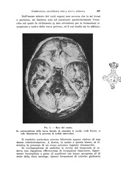 Il Valsalva rivista mensile di oto-rino-laringojatria