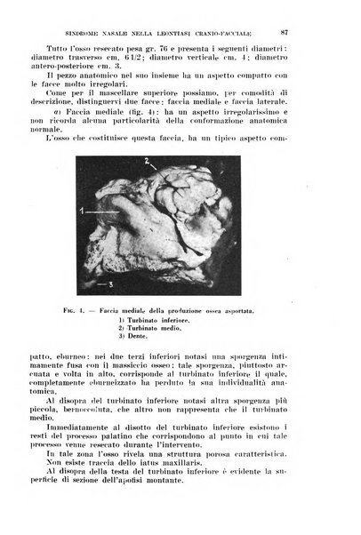 Il Valsalva rivista mensile di oto-rino-laringojatria